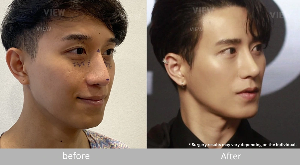 Male Rhinoplasty before and after case demonstrating enhanced nose definition and balanced facial proportions in three-quarter view