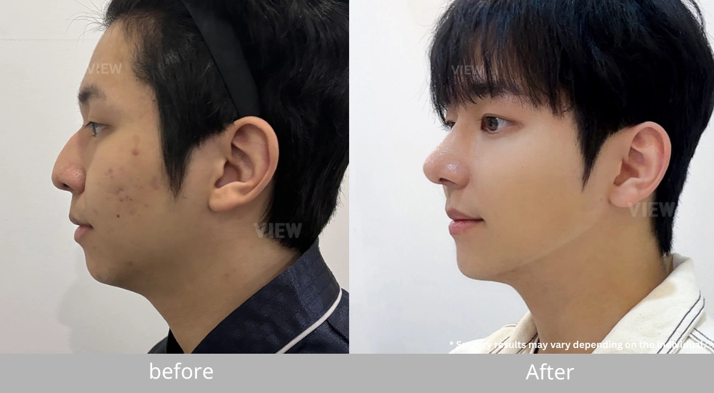 Male Rhinoplasty before and after results in Seoul showing improved nasal bridge height and refined tip projection from side profile
