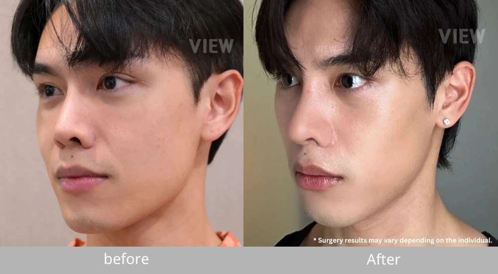 male rhinoplasty doctor seoul before after 03