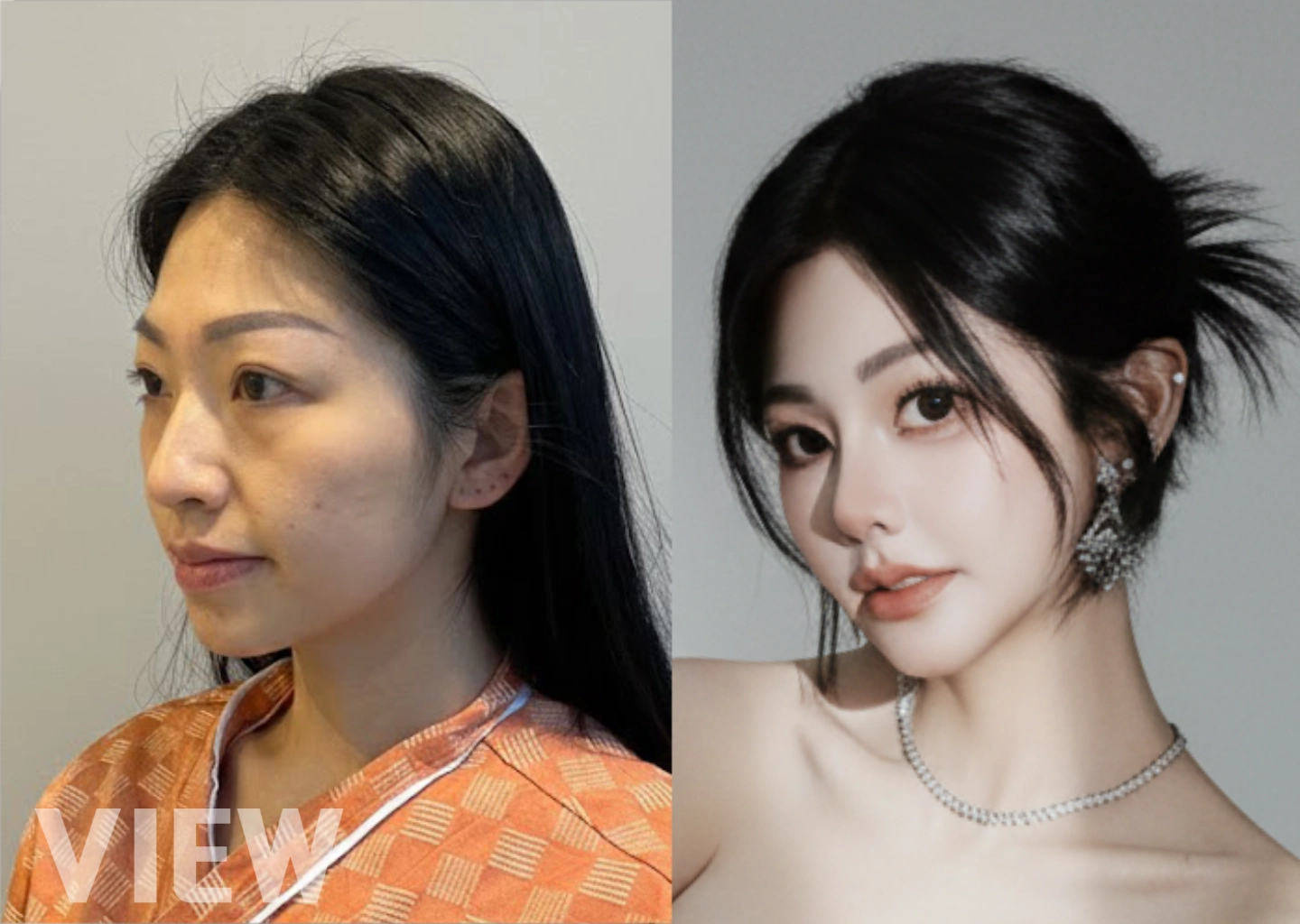 Primary Rhinoplasty in Seoul before and after comparison showing refined nasal bridge and tip definition in primary nose surgery