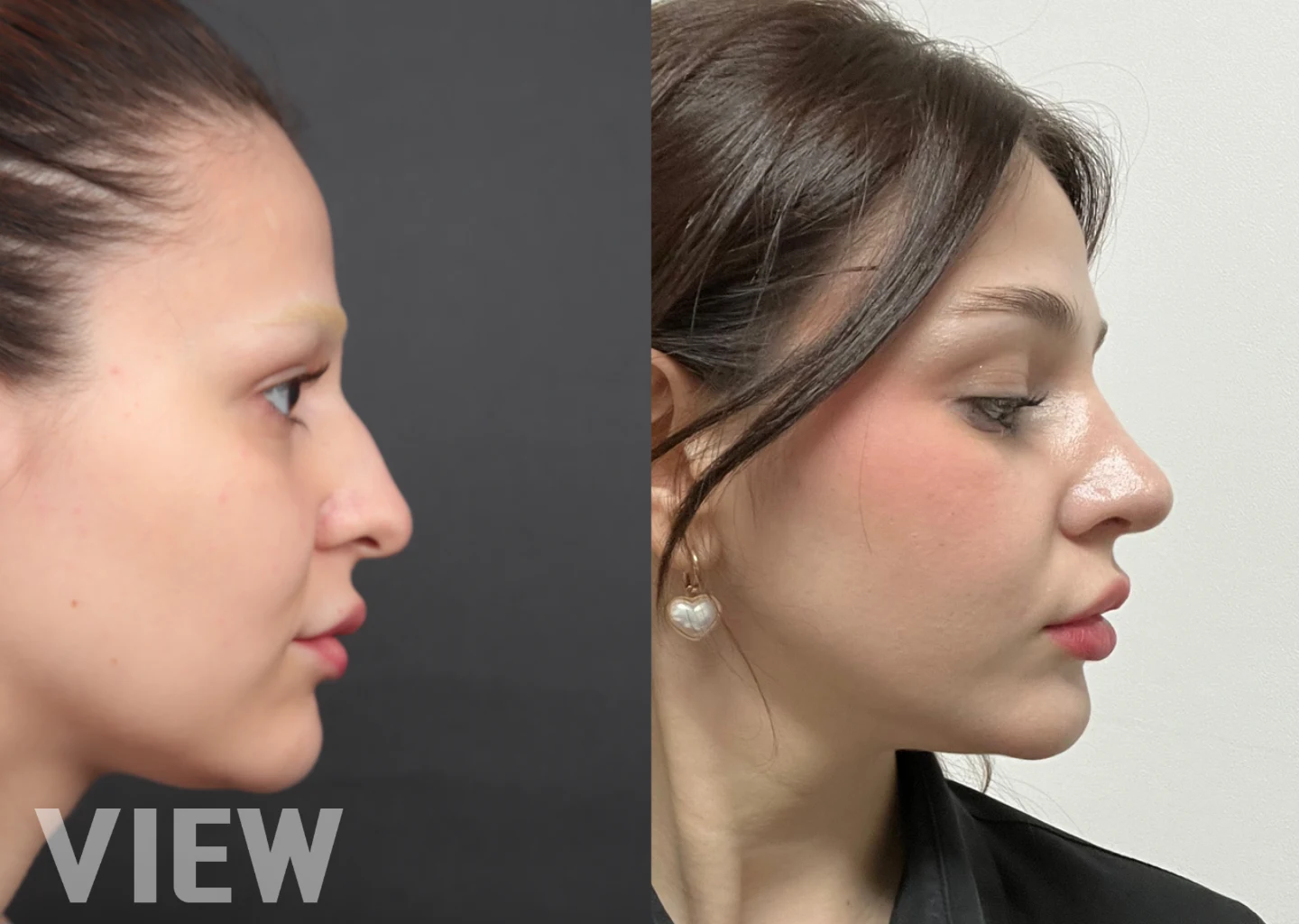 A side profile comparison of a patient before and after rhinoplasty in Seoul at View Plastic Surgery, showing realistic surgical results