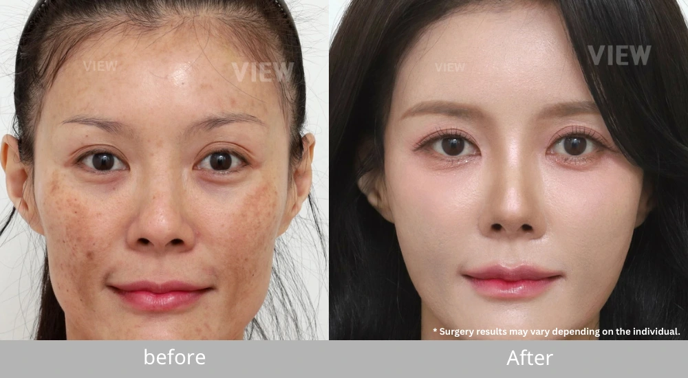 Stem Cell Therapy combined with fat grafting and PRP in Korea before and after results showing facial volume restoration, improved skin texture, and overall skin regeneration