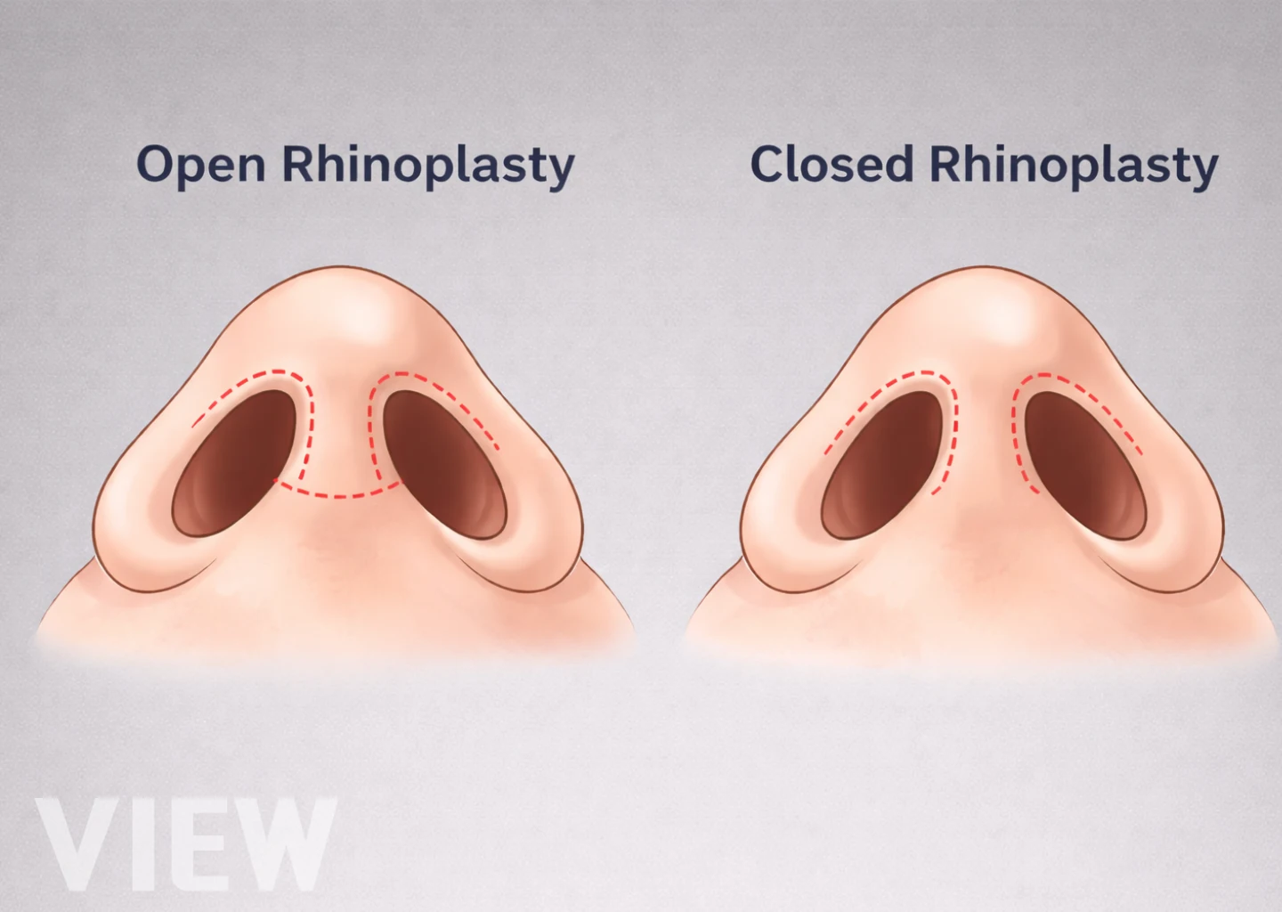 A diagram comparing open vs closed rhinoplasty incision sites, showing the external columellar incision for open surgery and internal incisions for closed surgery in Seoul.