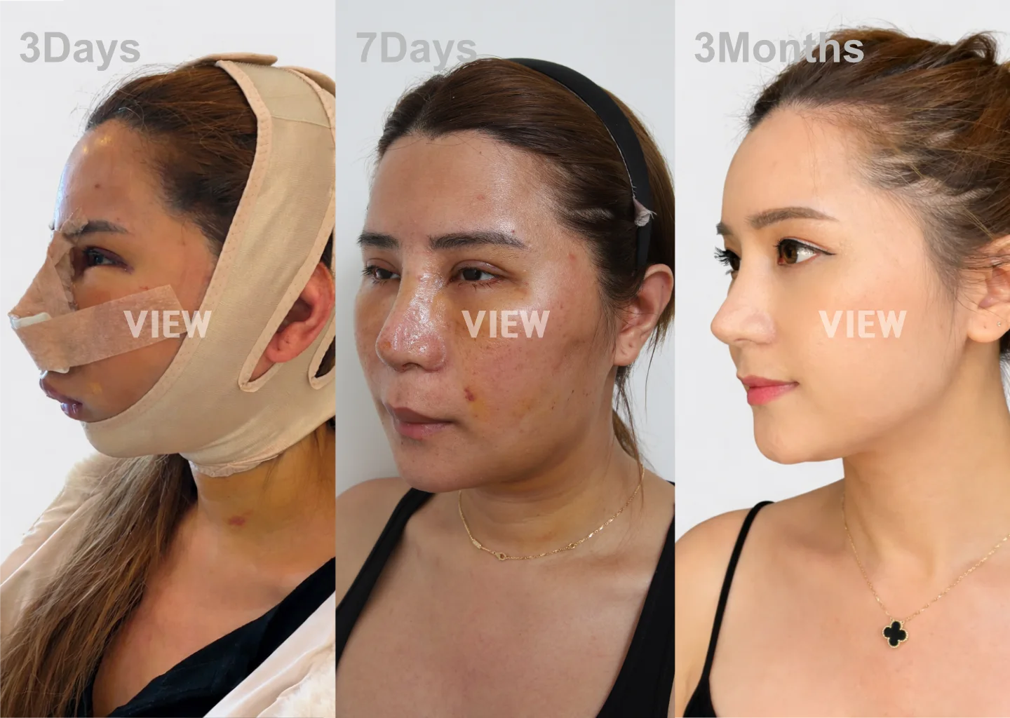 A real-life rhinoplasty recovery timeline showing a patient's progress from 3 days post-op with bruising to a fully healed side profile after 3 months in Seoul.