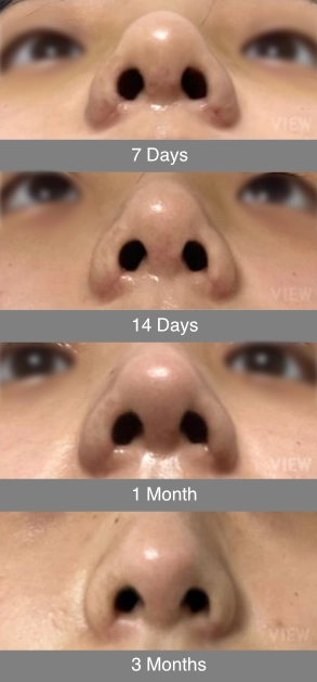 A frontal view comparison of rhinoplasty recovery progress at 7 days, 14 days, 1 month, and 3 months, showing the gradual reduction of nasal tip swelling.