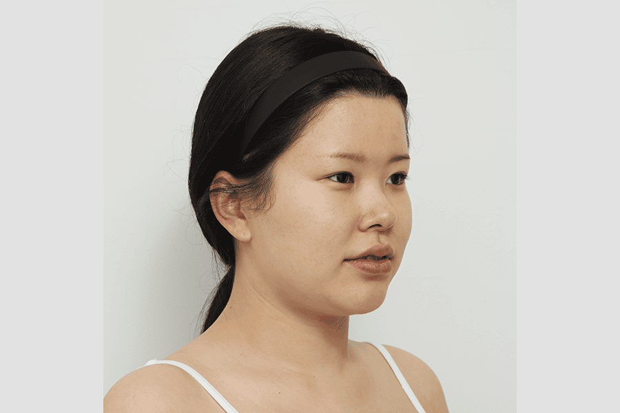 Before face liposuction surgery