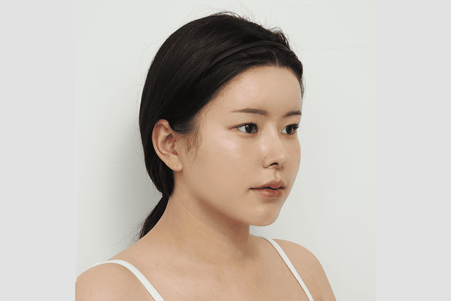 After face liposuction surgery