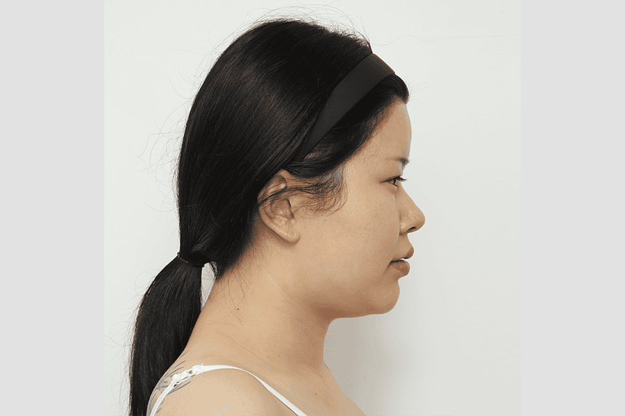 Before face liposuction surgery