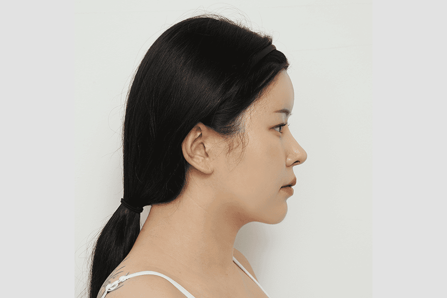 After face liposuction surgery
