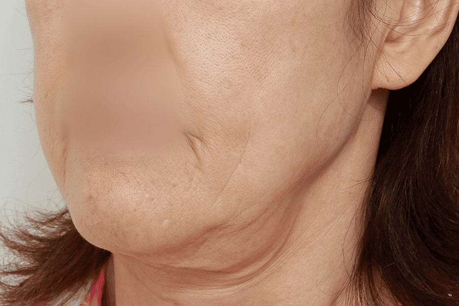 Before face liposuction surgery