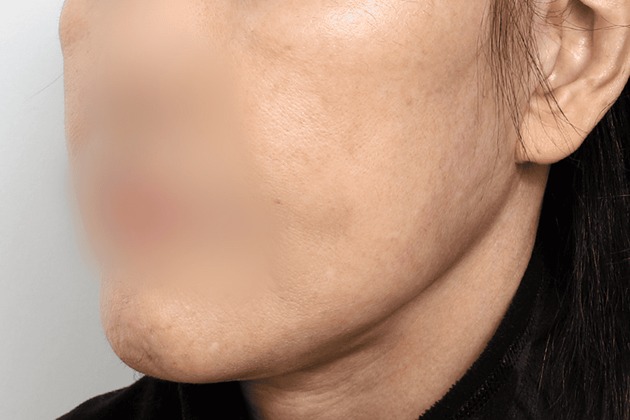 After face liposuction surgery