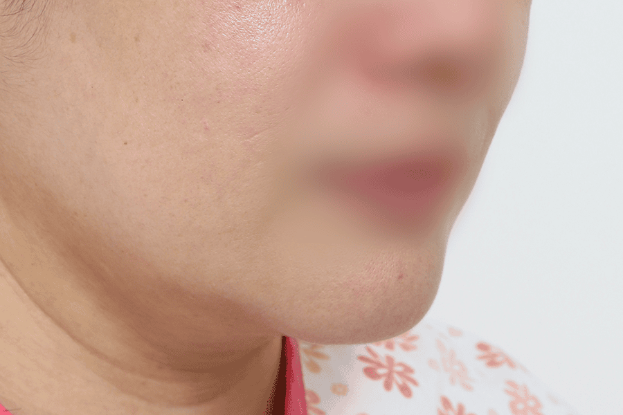 Before face liposuction surgery