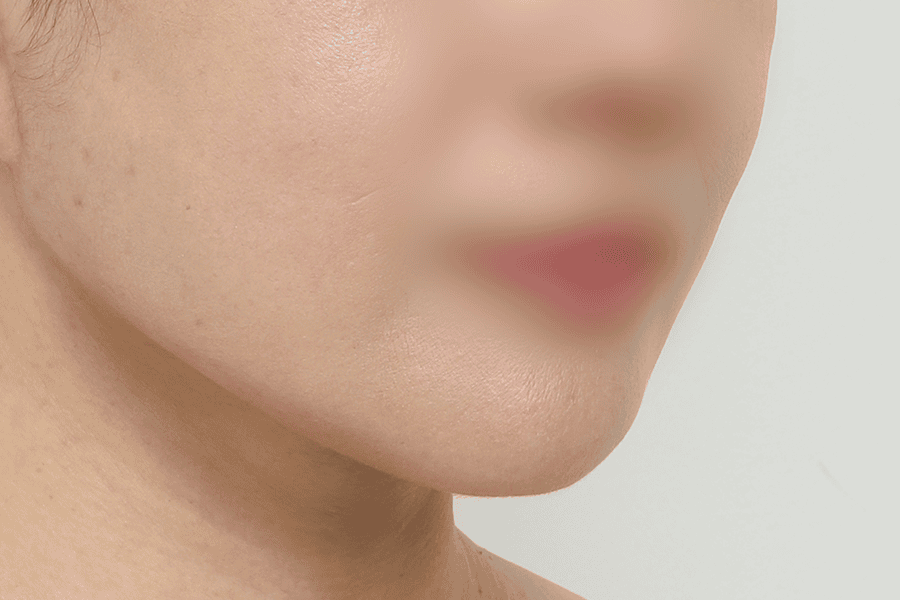 After face liposuction surgery