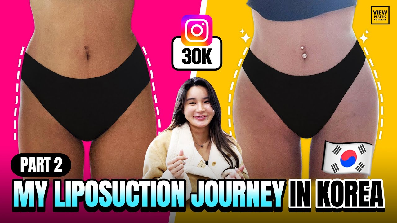 My Liposuction Journey in Korea Vlog (Part 2)
