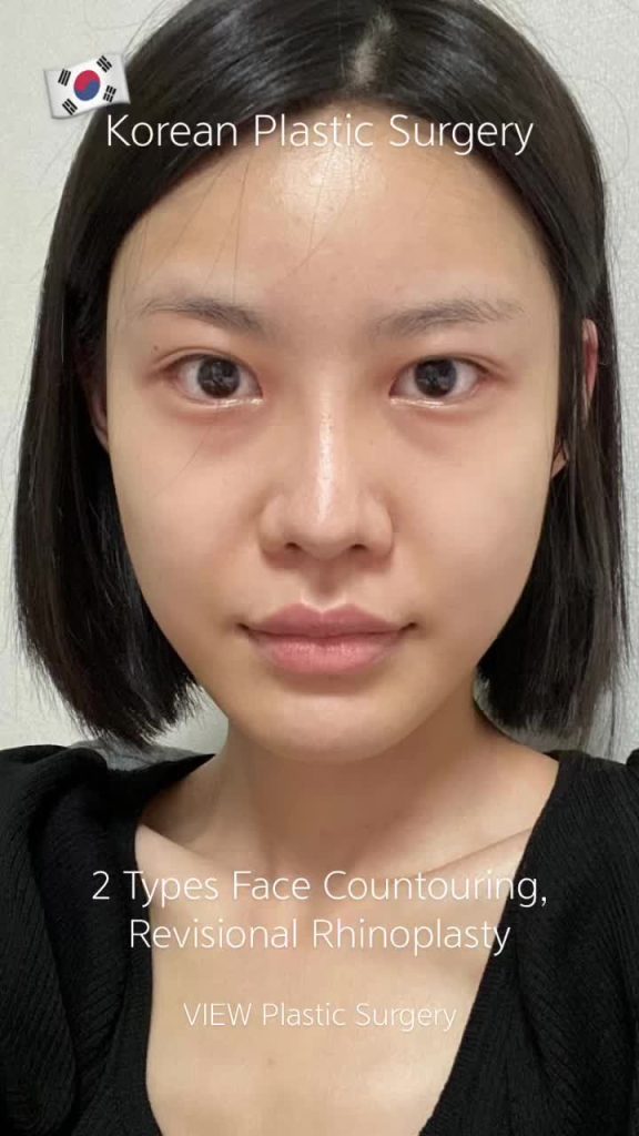 #과거와현재 #koreanplasticsurgerybeforeandafter #fyp #fy #seoul #viewplasticsurgery #kbeauty #kpop