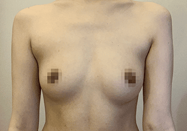 Before motiva preserve surgery