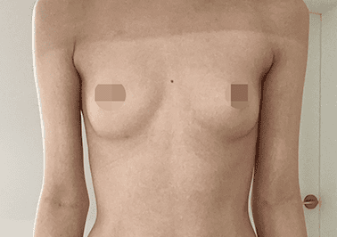 Before motiva preserve surgery