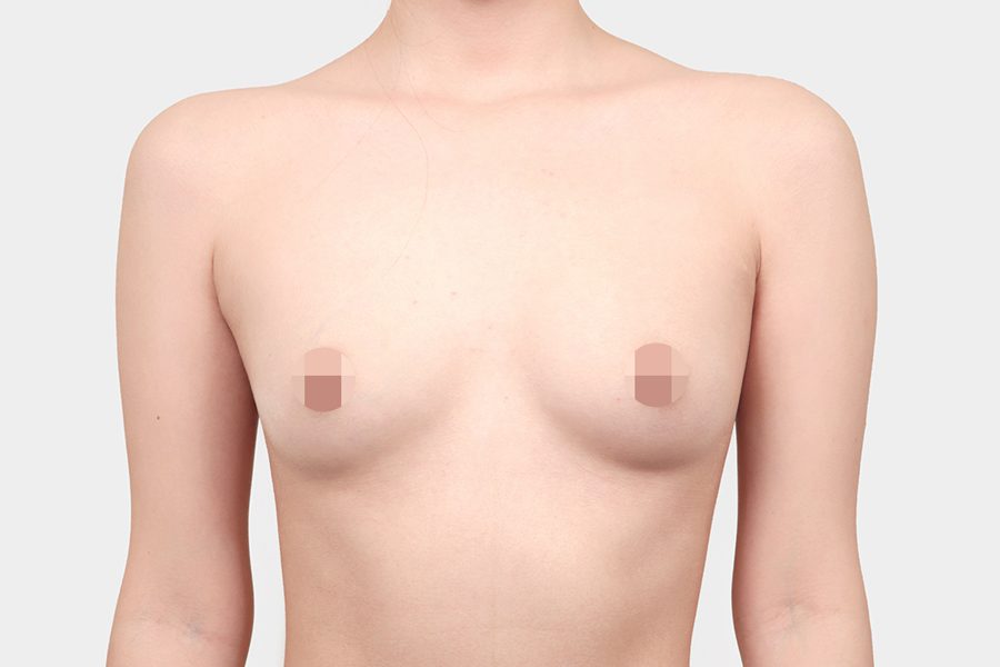 Before motiva preserve surgery