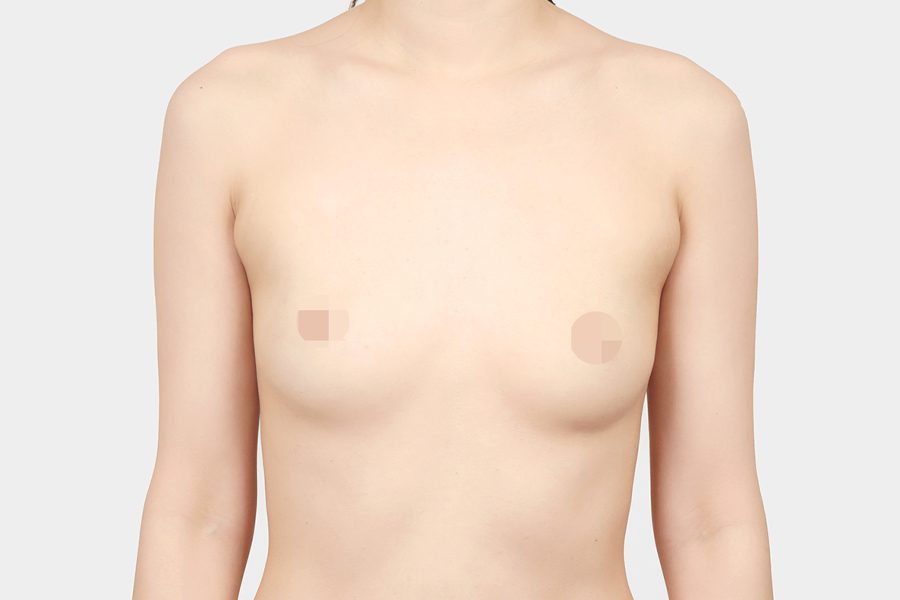 Before motiva preserve surgery