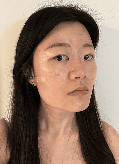Before facial contouring surgery in Korea