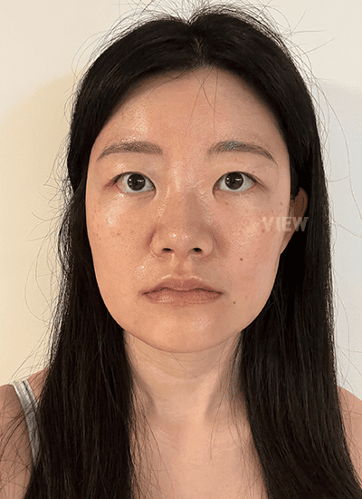 Before facial contouring surgery in Korea