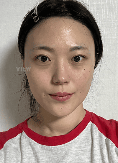 I was nervous before facial contouring surgery in Korea