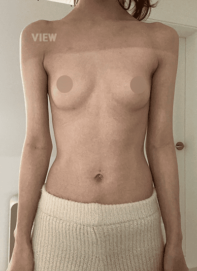 Breast Augmentation in Korea