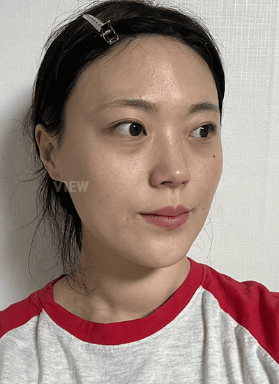 Review facial contouring surgery at View Plastic Surgery, Korea