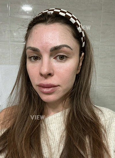 Mini face lift at View Plastic Surgery in Korea