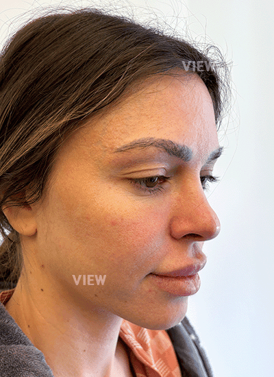 Face lift at age of 30