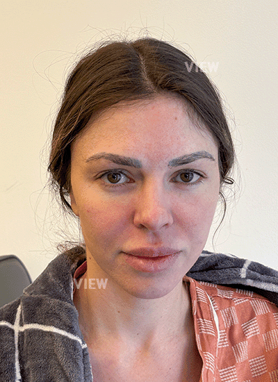 Face lifting surgery in Korea