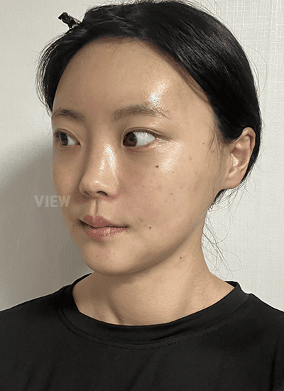 Exactly two weeks after facial contouring surgery, I went to the hospital to remove the stitches inside my mouth.