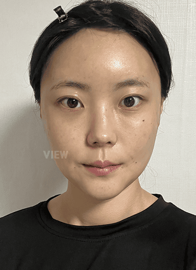 Is It Painful to Remove Stitches Two Weeks After Facial Contouring Surgery?