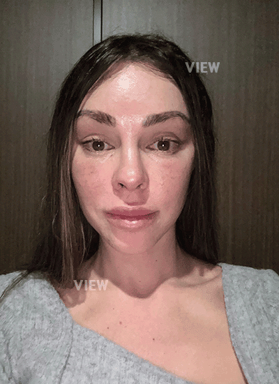 Two weeks post-op face lift and still bruising