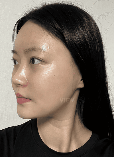 Why Did My Face Still Look Very Swollen 3 Weeks After Facial Contouring Surgery?