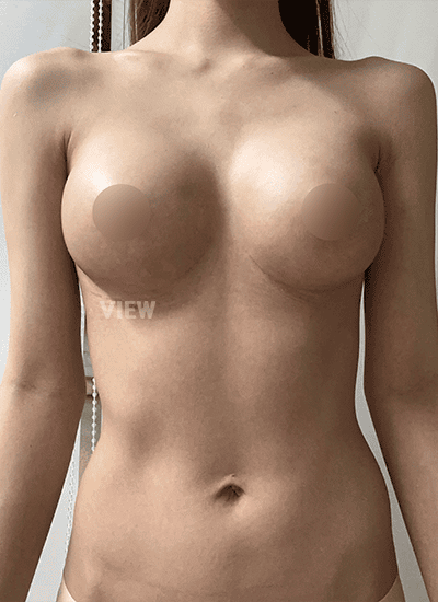 3 Months Post Breast Surgery at View Plastic Surgery