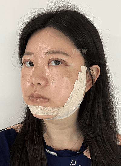 3 days after facial contouring surgery in Korea