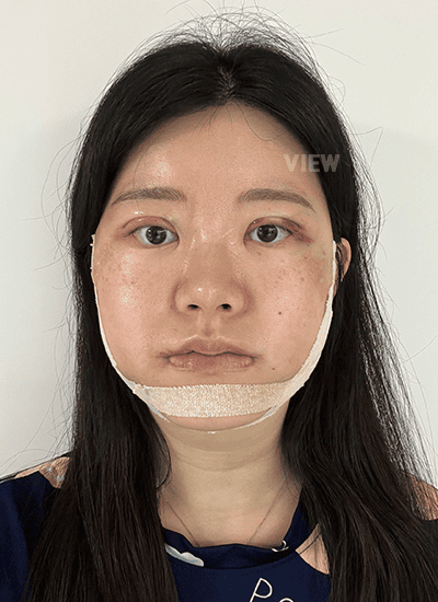 Square jaw surgery at View Plastic Surgery Korea