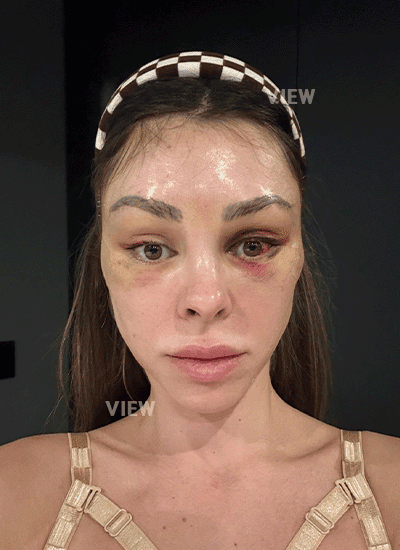 Face Lift in Korea
