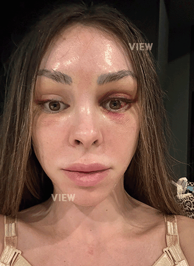 3 days after face lift surgery