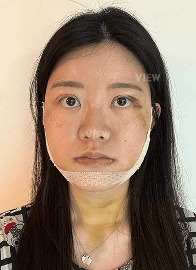 1 Week Post-Op Facial Contouring Surgery in Korea