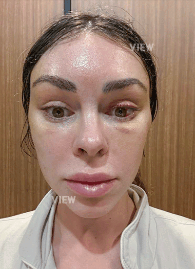 Review 1 week after face lift surgery