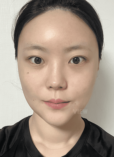 1 month after facial contouring surgery at Korea