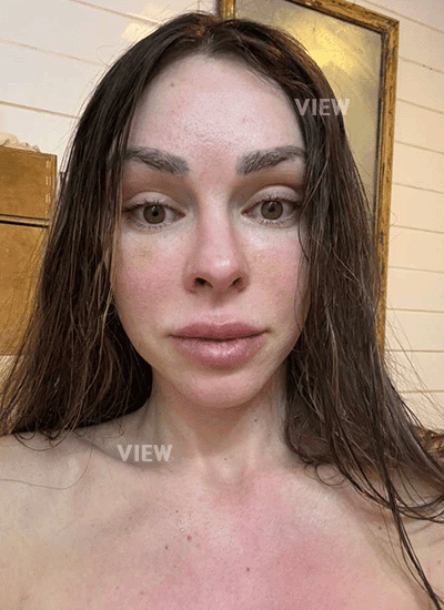 At just one month post-op, my face already feels tighter and more lifted