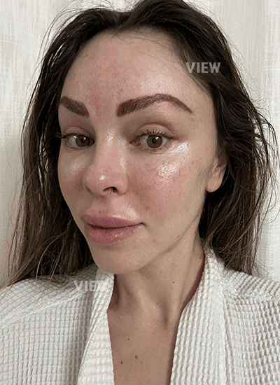  An Honest Facelift Update from a Foreign Patient in Korea