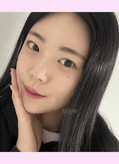 At three months after facial contouring surgery, upper-face swelling often improves first while chin swelling lingers longer.