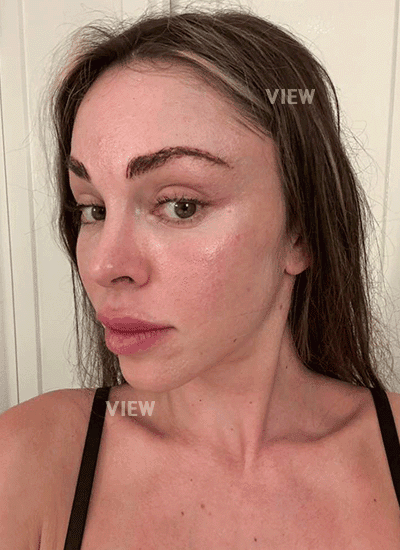My Korea Facelift Results