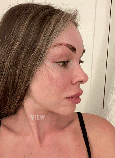 It's been three months since my face lift at View Plastic Surgery