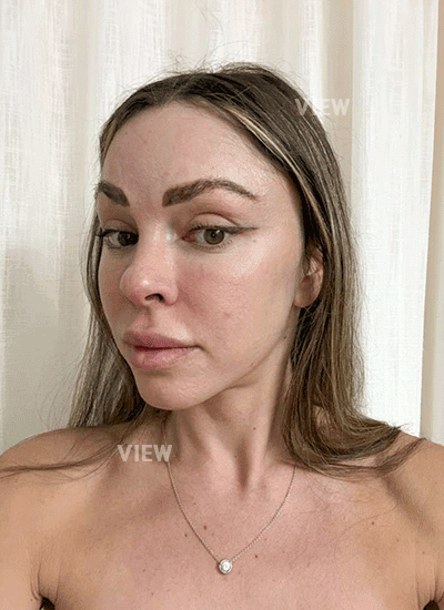 Korean face lift
