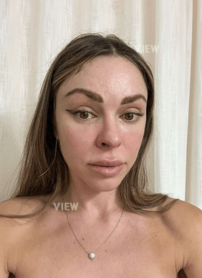 mini facelift and temporal lift